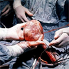 1e geslaagde harttransplantatie
